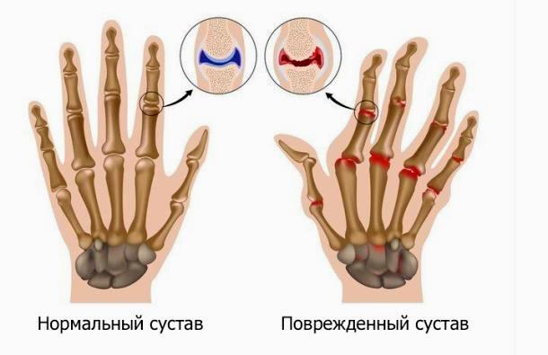 Схематическое отображение артрита пальцев рук
