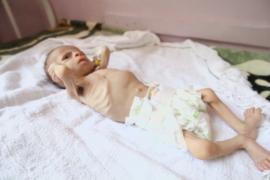 ООН: 1,4 млн детей — на грани голодной смерти