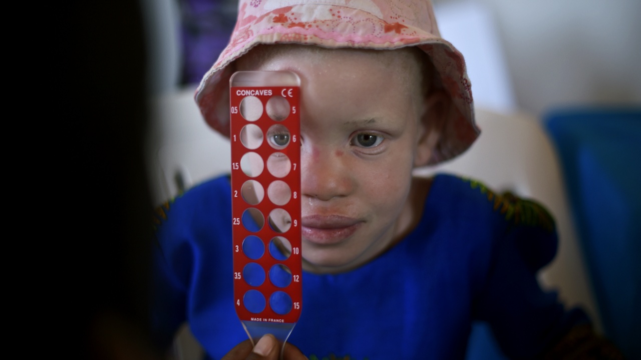 Пострадавшим детям-альбиносам из Танзании помогут в США
