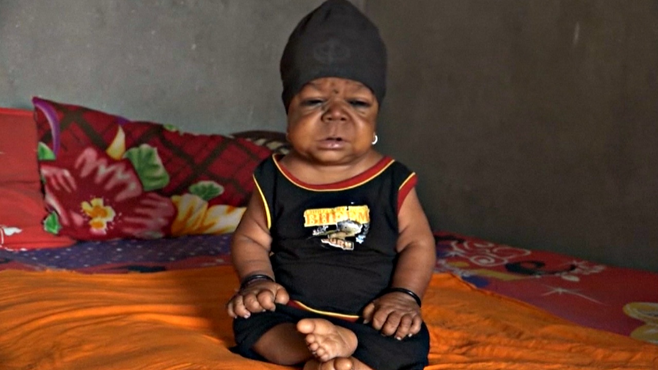 Индиец 22 года живёт взаперти в теле младенца