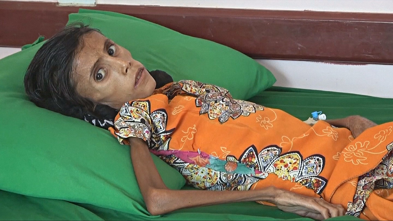 Голодающая девочка – лицо йеменской войны и гуманитарного кризиса