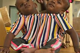 Сиамских близнецов из Сенегала не смогут разделить