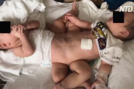 В Перу разделили сиамских близнецов, сросшихся нижними частями тела