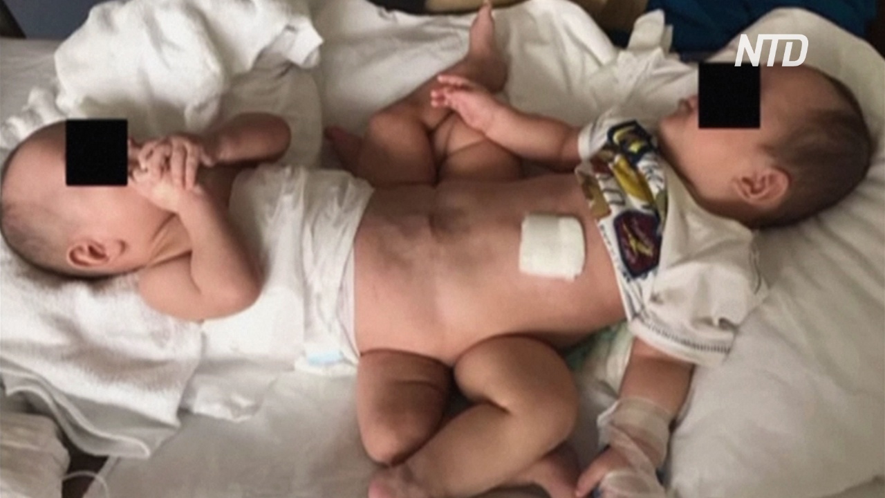В Перу разделили сиамских близнецов, сросшихся нижними частями тела
