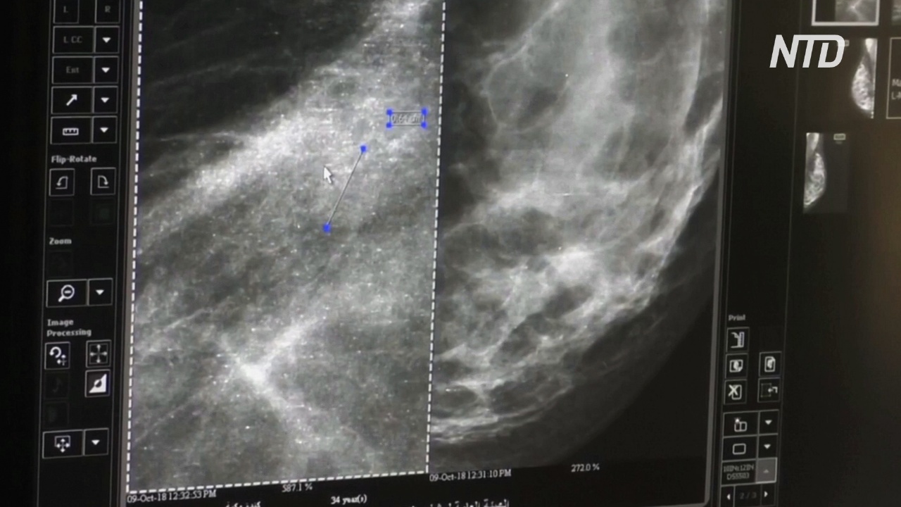 ВОЗ: рак груди обогнал рак лёгких как наиболее частую форму рака в мире