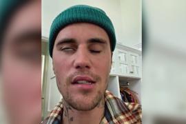 У Джастина Бибера парализовало половину лица