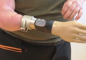 Миоэлектрический протез помог женщине избавиться от фантомных болей