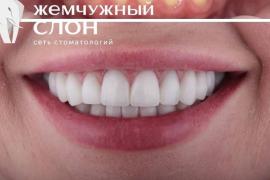 Керамические коронки в Омске: новейшие технологии в клинике «Жемчужный Слон»