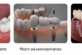 Как происходит протезирование зубов: показания и противопоказания, этапы