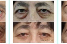 Психологические аспекты блефаропластики: Как операция влияет на самооценку