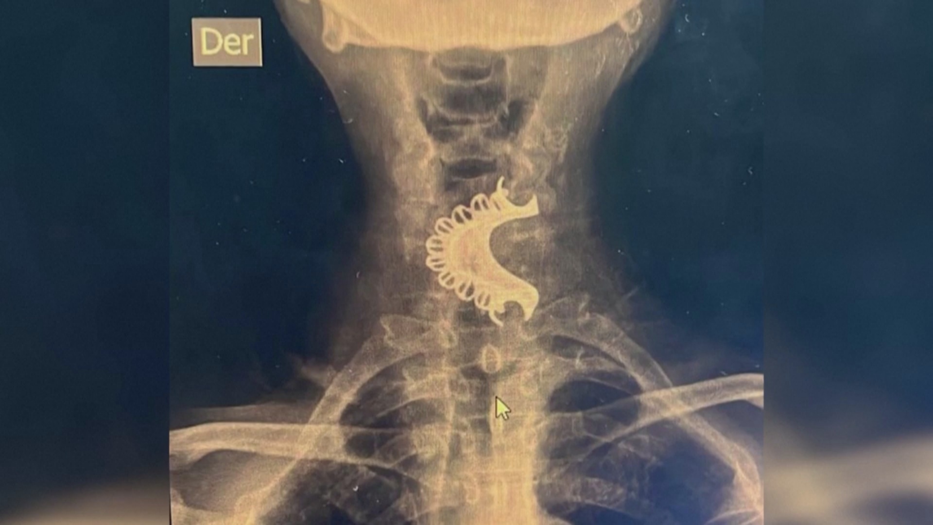 В Перу спасли пожилого мужчину, проглотившего свой зубной протез