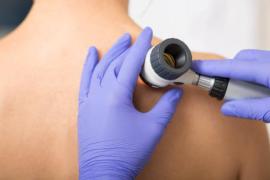 Псориаз, дерматит и экзема: симптомы, разница, лечение