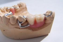 Чем отличаются бюгельные протезы от других видов?