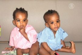 Сиамских близнецов из Африки разделили в Индии