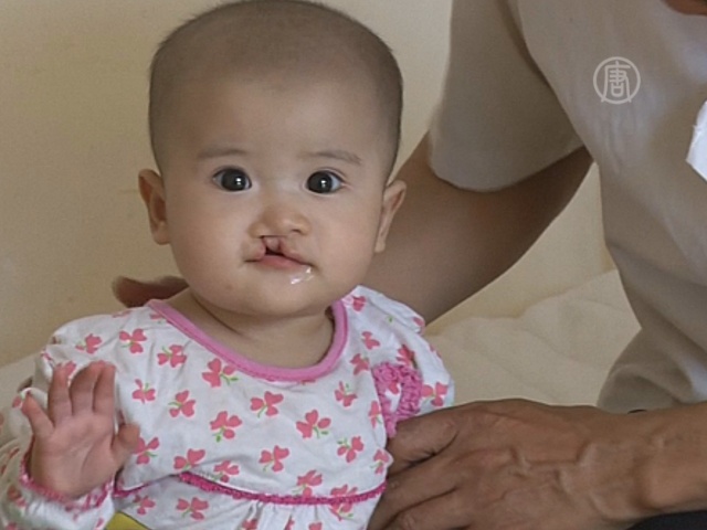 Детям с «заячьей губой» делают бесплатные операции