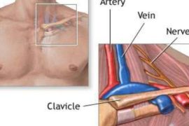 Операции на сонных артериях