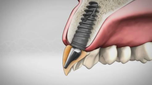 Alpha Bio имплантаты это крепкие и здоровые зубы